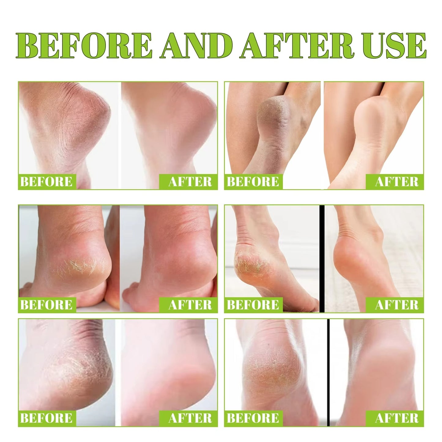 South Moon - 42% Urea Cream + 2% Salicylic Acid