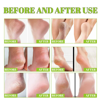 South Moon - 42% Urea Cream + 2% Salicylic Acid
